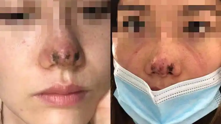 深圳:一女子玻尿酸隆鼻失败皮肤溃烂,向富华美容医院索赔25万余元