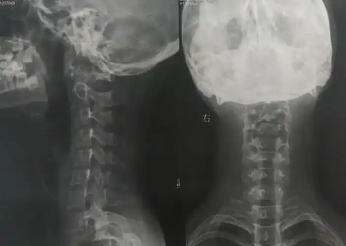 "颈椎反弓"是什么鬼?