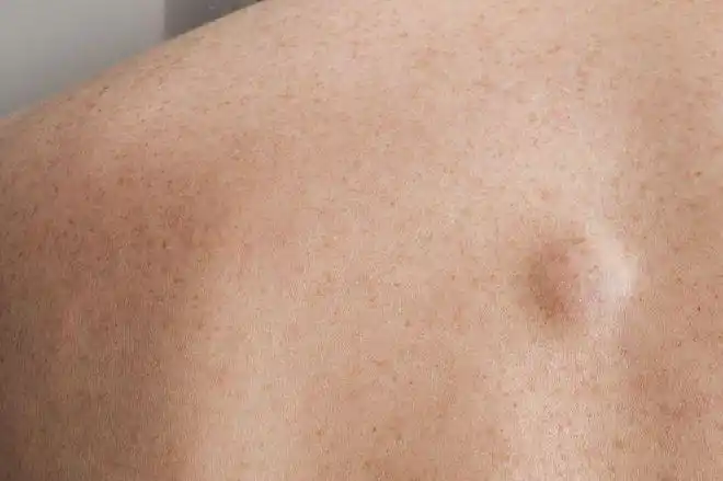 脂肪肉瘤是比较常见的一种软组织肉瘤,是成年人较常见的恶性软组织