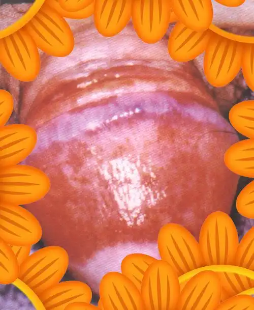 得了「浆细胞性包皮龟头炎」别着急,看这文章就清楚了 - 好大夫在线