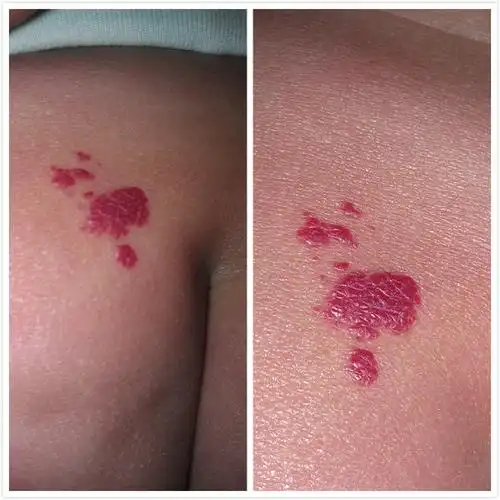 6个月大的宝宝屁股上一小块血管瘤 该如何治疗,什么时候治疗最好 武汉