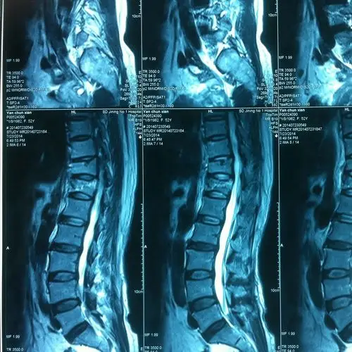 腰椎骨折保守治疗效果较好 病例分享