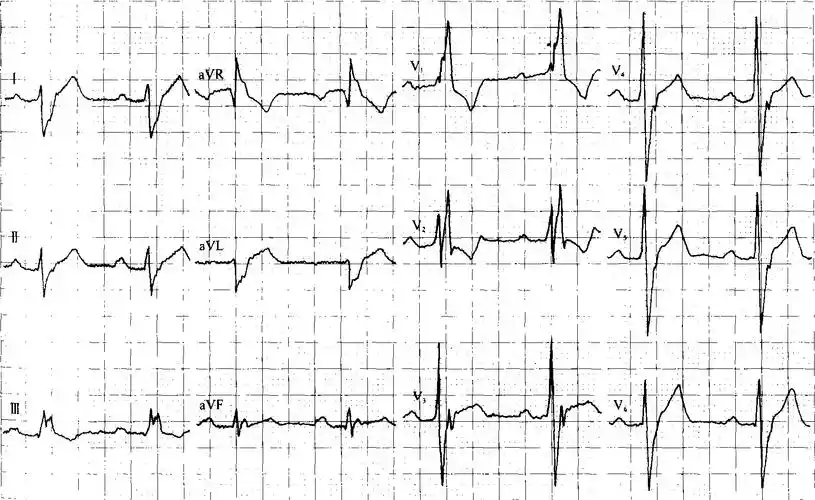 11-4 p-r间期延长合并完全性右束支传导阻滞加左后分支阻滞-精编心电