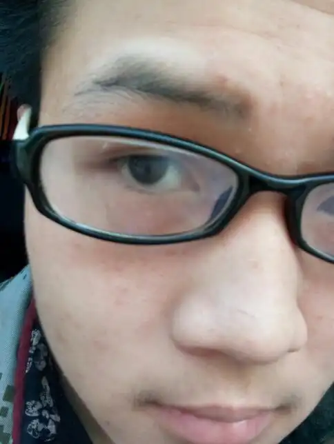 我眉毛的地方发白,是肉,不是眉毛.咋回事啊,我才16啊,不会是白癜风吧!