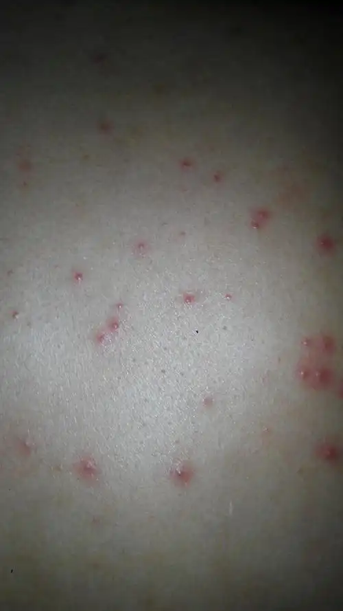 附件:请问这是什么症状,是梅毒和艾滋吗?