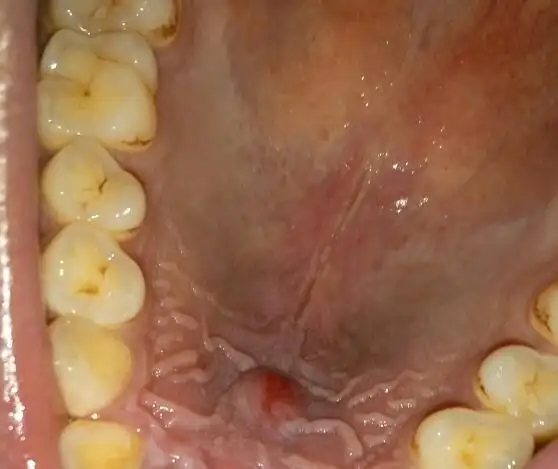 口腔上颚疼痛起泡,总感觉里面好像有水一样舌头顶着会动感觉痛到神经