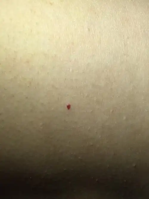 我男朋友身上长了很多这种红色血点,是什么东西.