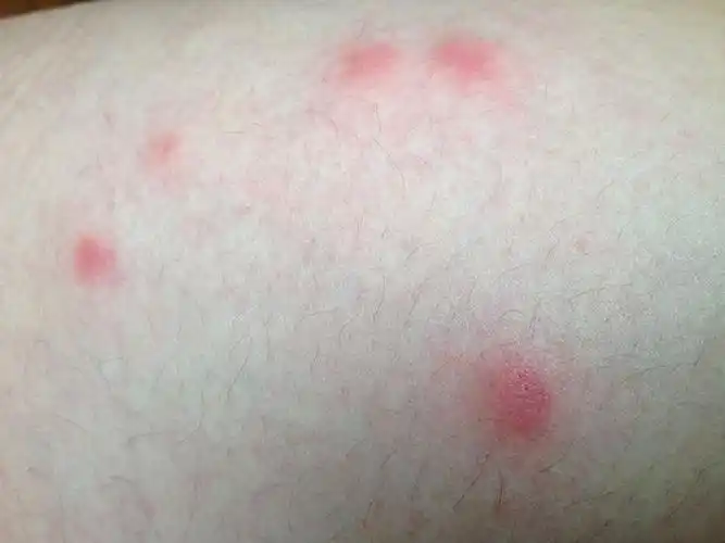 大腿外侧长红色点点,挠了就越来越痒,请问这是什么?