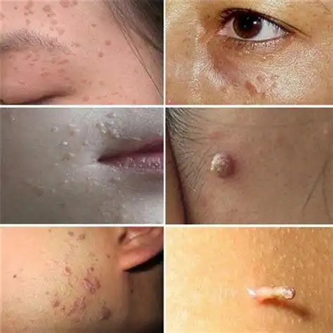 狗狗眼睑上长了个肉瘤怎么办?