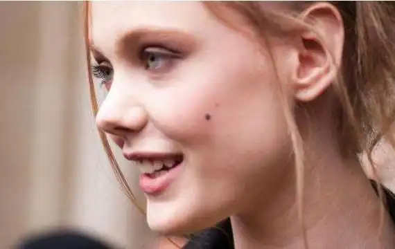 痣上长毛的运势解析事业好财运好