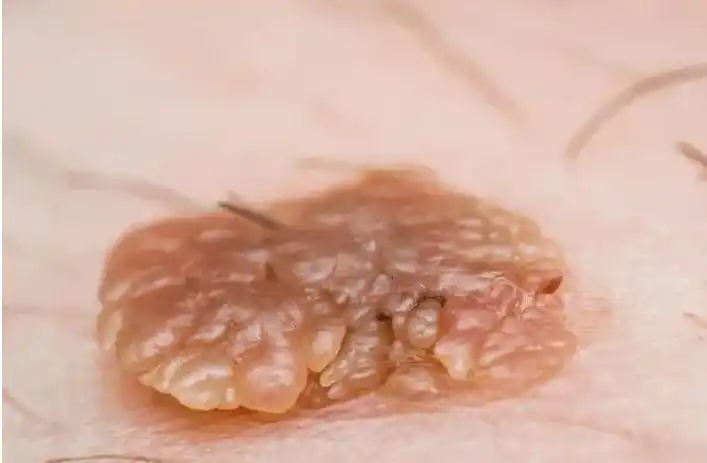 菜花病 (1)_有来医生