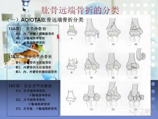 肱骨髁间骨折手术入路及固定方式的选择 - 丁香园