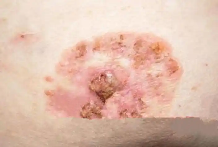 中期尖锐湿疣图片_有来医生