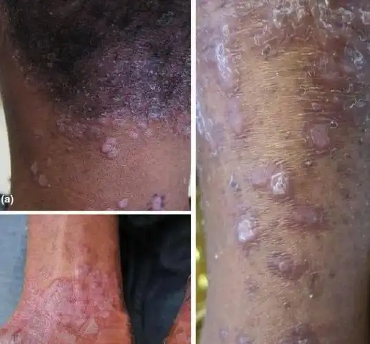 男梅毒初期图片40