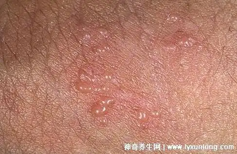 男性下面感染早期症状图片,传染性软疣/梅毒/尖锐湿疣/淋病 — 神奇