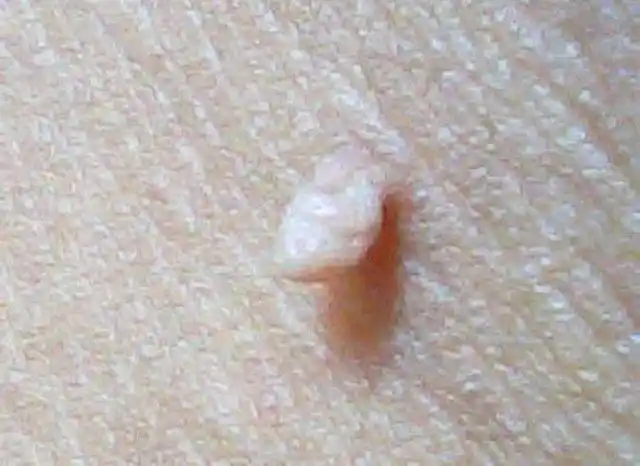 医生来揭秘了,乱抠早晚会出事|纤维瘤|肿瘤|手术|疙瘩_网易订阅