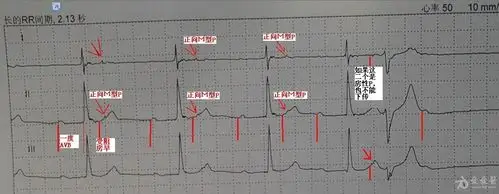 房性早搏后面可以跟个室早吗