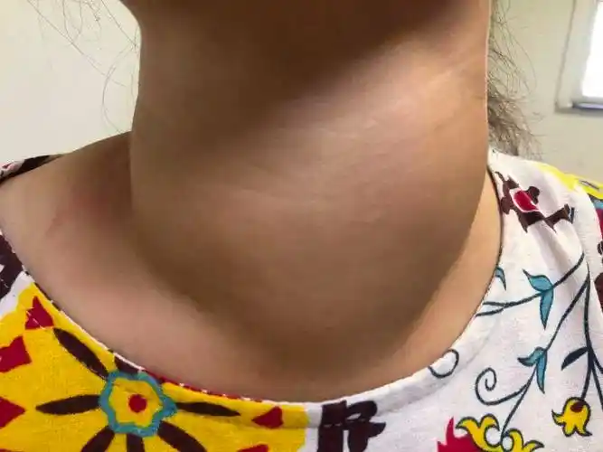 这十大症状,告诉你甲亢对日常生活的影响!_患者_甲状腺_功能