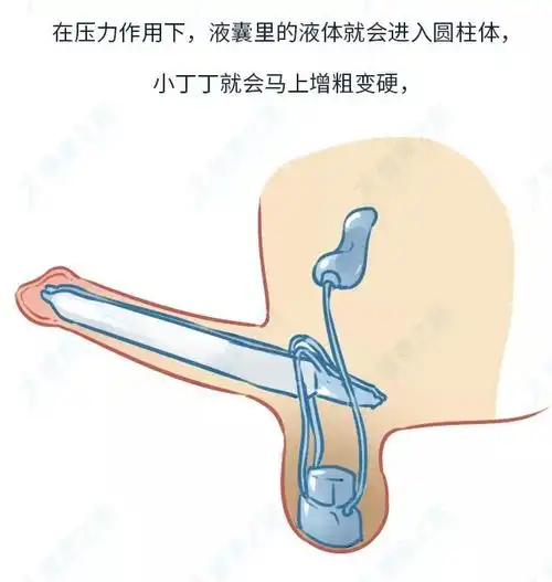 你听说过男生隆丁手术吗