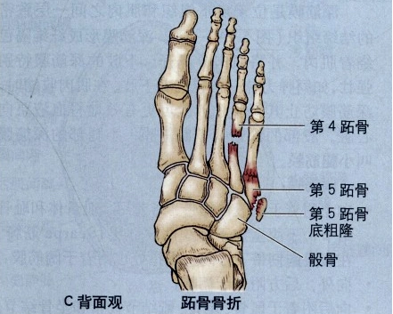 由此常产生一三骨,经验不足的放射科医师可能会将此三角骨误诊为骨折.