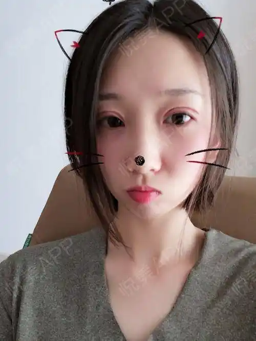 开内眼角术后30天_全切双眼皮术后30天_开眼角术后30天_双眼皮术后30