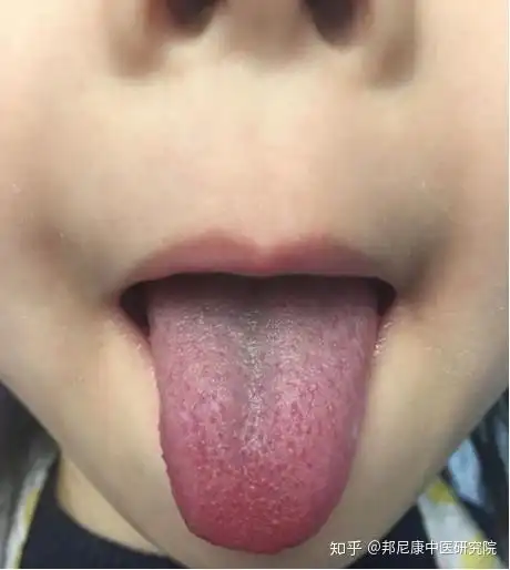 肺热宝宝的舌象