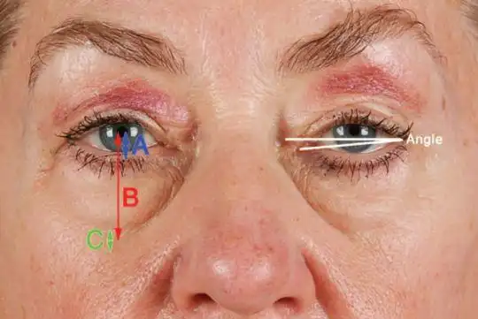 泪沟的病理解剖3眶颧韧带的约束作用——"v"形畸形泪沟的病理解剖2