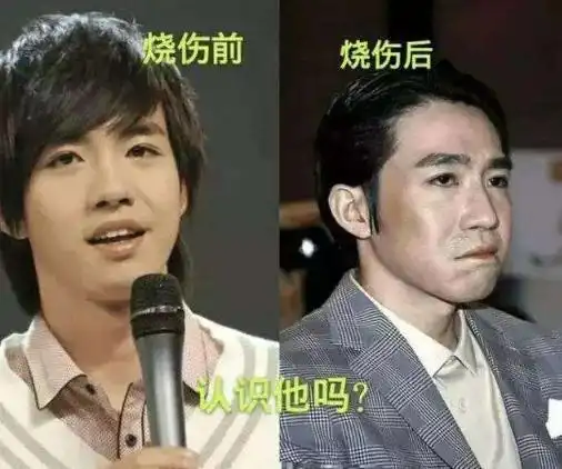 被大火烧伤,俞灏明美男子变"丑八怪",索赔5000万,女友已嫁人