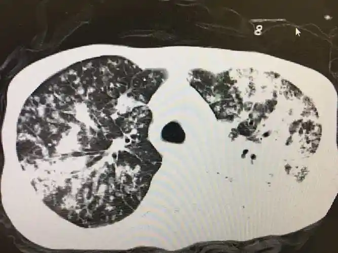 一例重症肺结核的资料