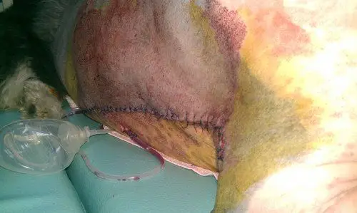 脂肪瘤切除手术day 1