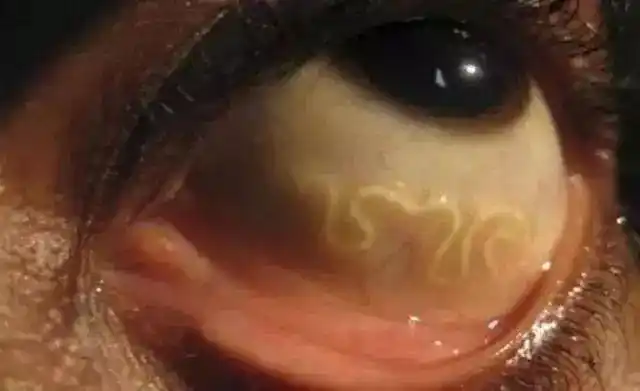 这个病例有点像影视剧中提到的蛊