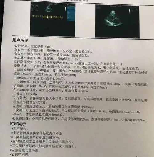 刃迎缕解陆军军医大学大坪医院心血管内科团队顺利完成