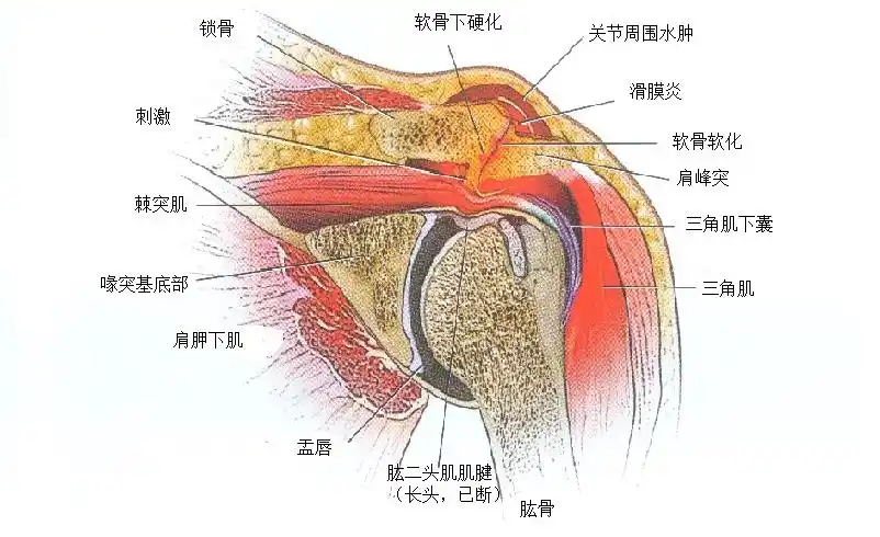 > 超声引导下肱二头肌肌腱炎注射技术