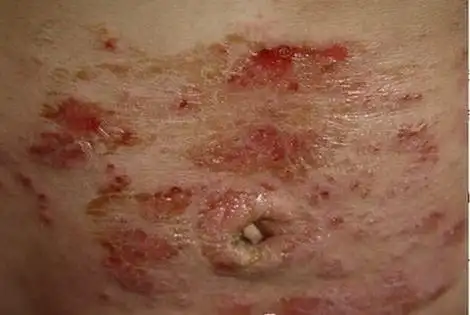 男人患有淋病会出现哪些症状