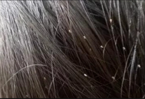 虱子卵图片是什么样子的?