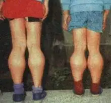 抗维生素d佝偻病