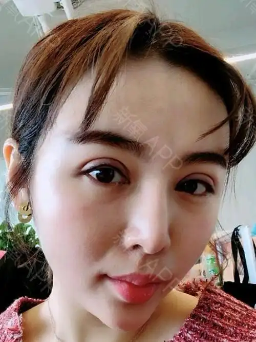 做完双眼皮10天了,不得不说恢复的真的好快,看着眼睛一天比一天好看