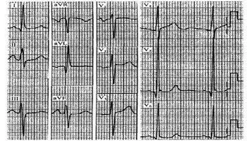 肺型p波 p pulmonale  是心房肥大的心电图表现之一,主要是肺源性心脏
