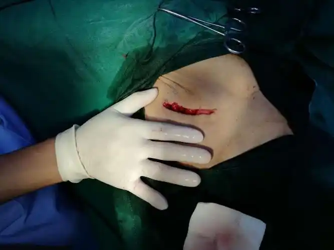 其它 官店分院成功实施首例腹壁脂肪瘤切除术 针对本次手术治疗,我院