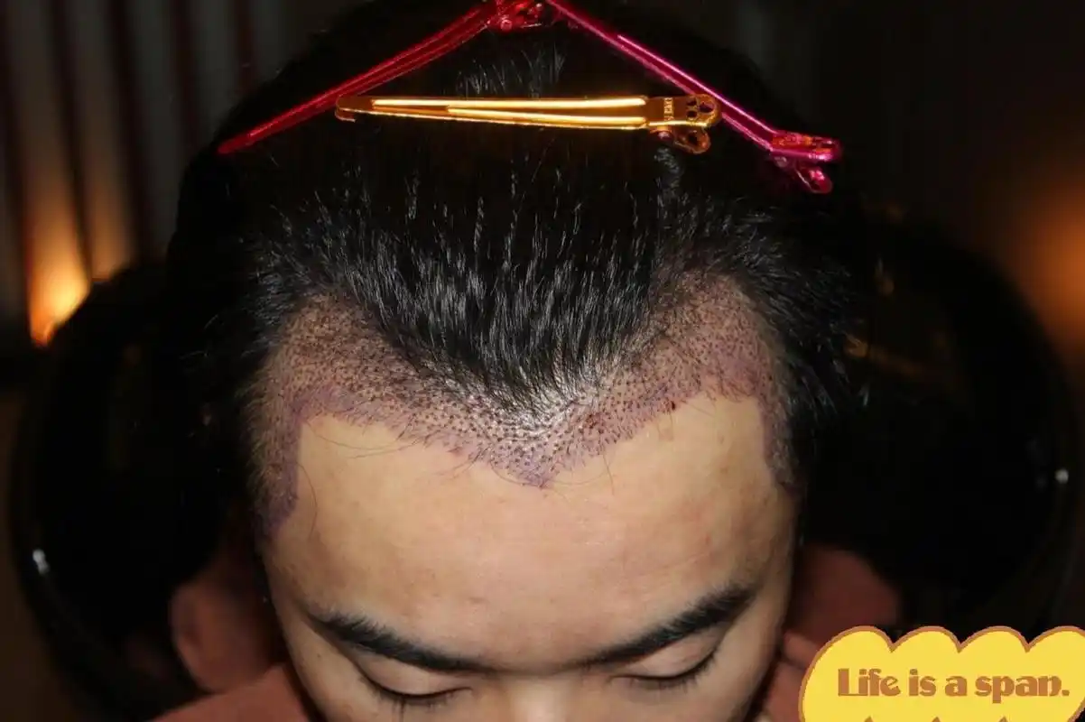 华晨宇整容,华晨宇整容前在医院拍的照片,前三张是华晨宇植发后去医院