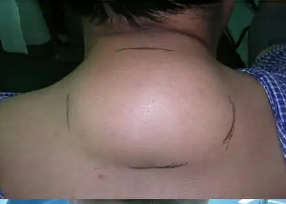 介绍一种简单的病,,,颈后脂肪瘤
