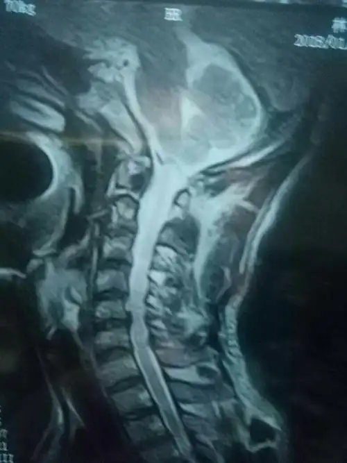 颈椎突出3节4节5节6节7微创手术好不好?