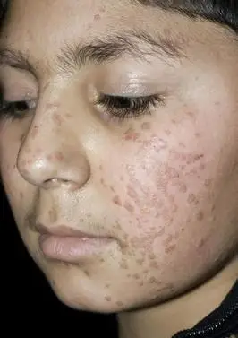 写美篇1,扁平疣多发于颜面,手背及前臂等处,表现为正常皮色或浅褐色