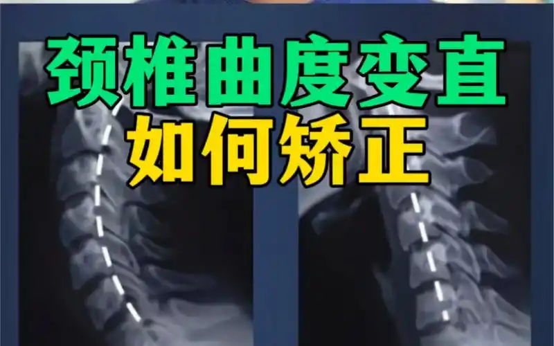 颈椎曲度变直如何矫正