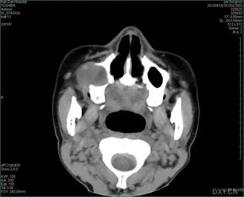 【病例讨论】上颌骨囊肿,请各位老师指点 [病例帖]