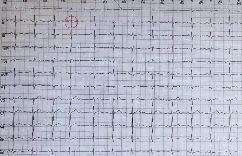 心电图不会看这10个诊断特征需牢记