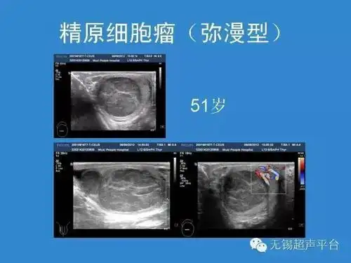 参考资料:超声医学(第六版)浅表气管超声诊断吴阶平泌尿外科学阴囊