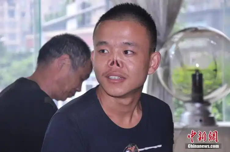 成都无鼻男孩装上新鼻开心自拍