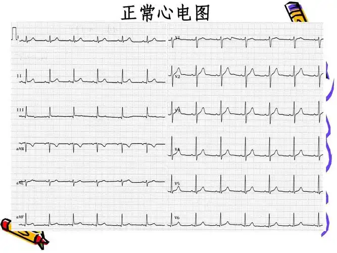 正常心电图