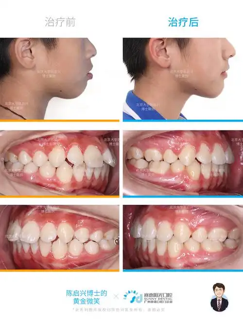 腺样体面容 嘴突 深覆盖 门牙缝过大矫正案例